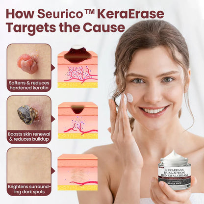 Seurico™KeraErase Dual-Action Renewal Cream 🔥