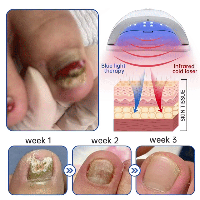 ODEIUN  Fungus Laser Therapy Device