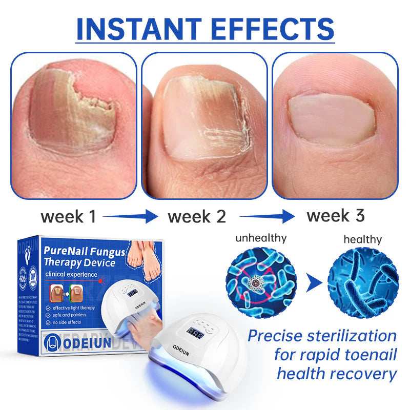 ODEIUN  Fungus Laser Therapy Device