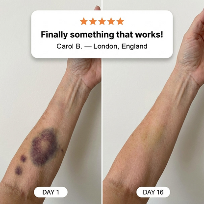 💥Over 100,000 units sold💕 - Cream to repair bruises and strengthen the skin